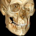 MCQs on Mandibular Fractures and Middle Third of Face Fractures